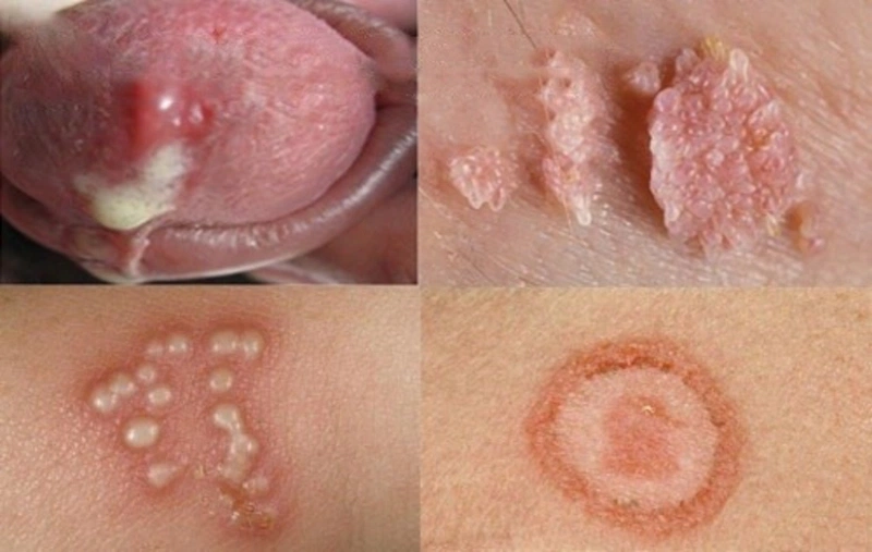 Bệnh xã hội gây ảnh hưởng đến sức khoẻ người mắc