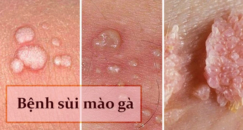 Bệnh xã hội phổ biến: bệnh sùi mào gà