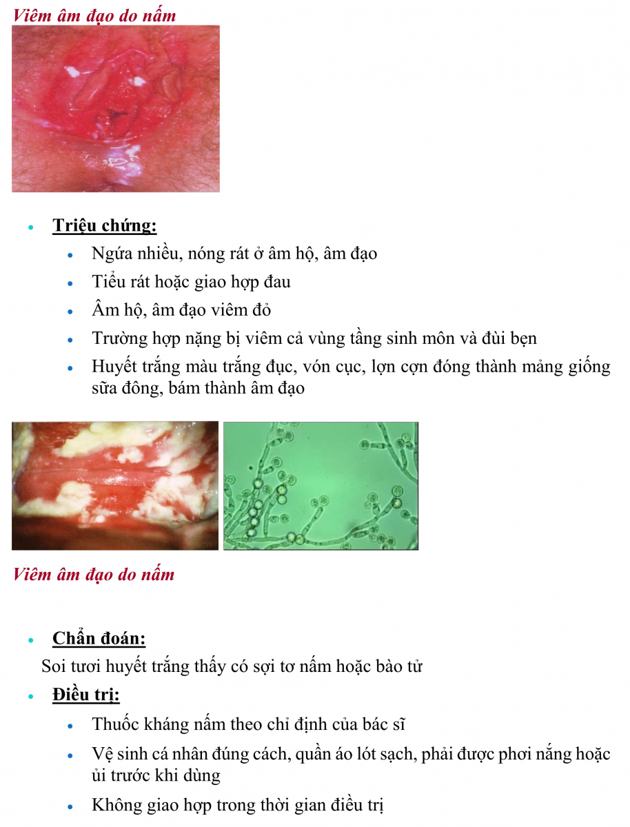 Viêm âm đạo do nấm: Nguyên nhân, triệu chứng, chẩn đoán  điều trị