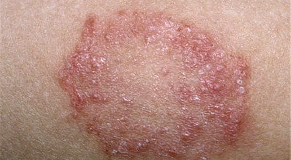 Bệnh Giang Mai: Nguyên nhân, Triệu chứng, Cách điều trị