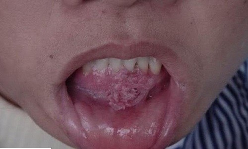 Bệnh sùi mào gà: Nguyên nhân, triệu chứng và cách điều trị hiệu quả Bệnh sùi mào gà: Nguyên nhân, triệu chứng và cách điều trị hiệu quả