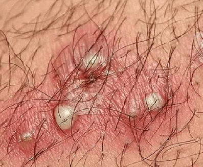 Mụn Rộp Sinh Dục Herpes: Nguyên Nhân, Triệu Chứng  Cách Điều Trị