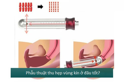 Những điều cần biết trước khi thực hiện thẩm mỹ vùng kín