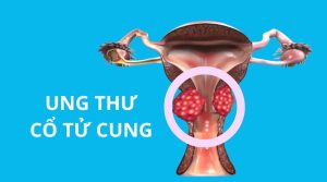 Dấu hiệu ung thư cổ tử cung: Nhận biết sớm để điều trị hiệu quả