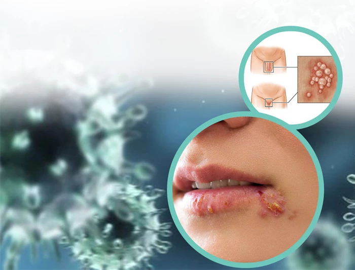 Mụn Rộp Sinh Dục Herpes: Nguyên Nhân, Triệu Chứng  Cách Điều Trị