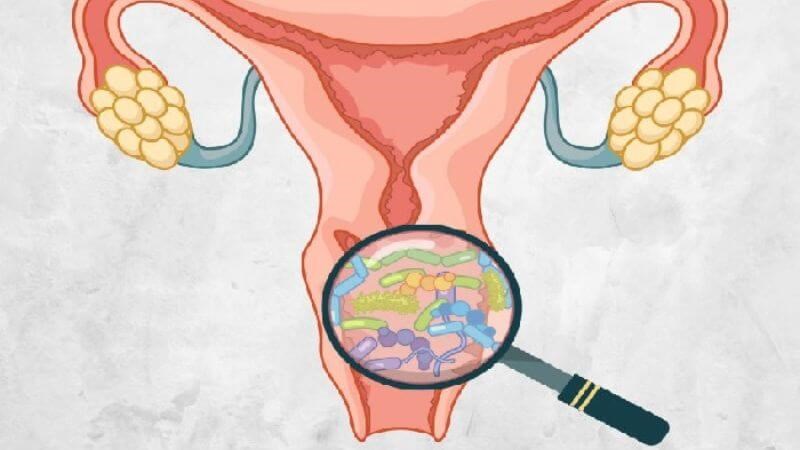 Viêm Âm Đạo Do Nấm Và Tạp Khuẩn: Phân Biệt Triệu Chứng  Cách Điều Trị