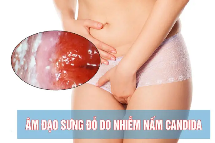 nấm candida âm đạo