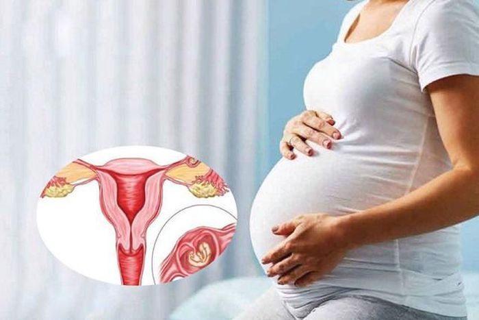 Chửa Ngoài Tử Cung Là Gì? Những Điều Cần Biết