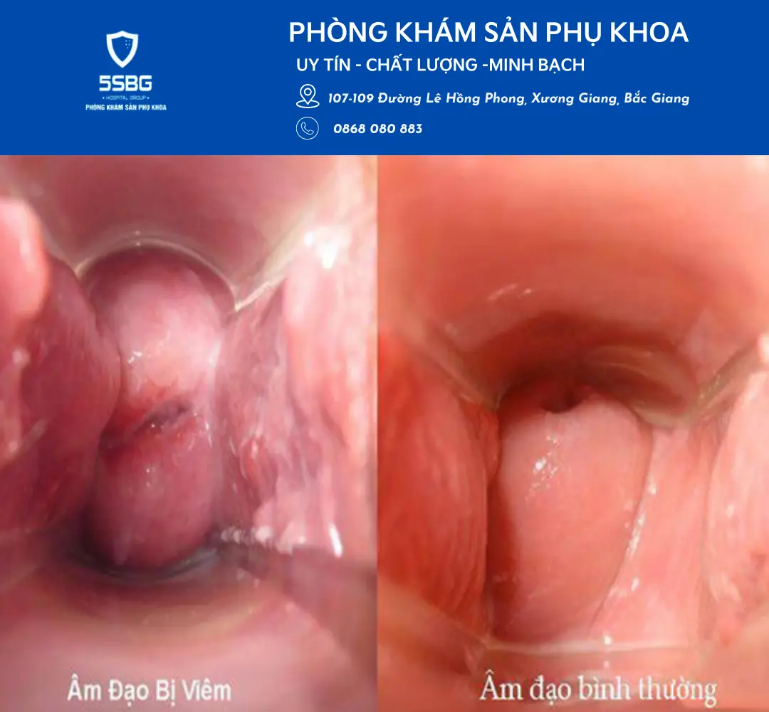 Viêm âm đạo do nấm Candida