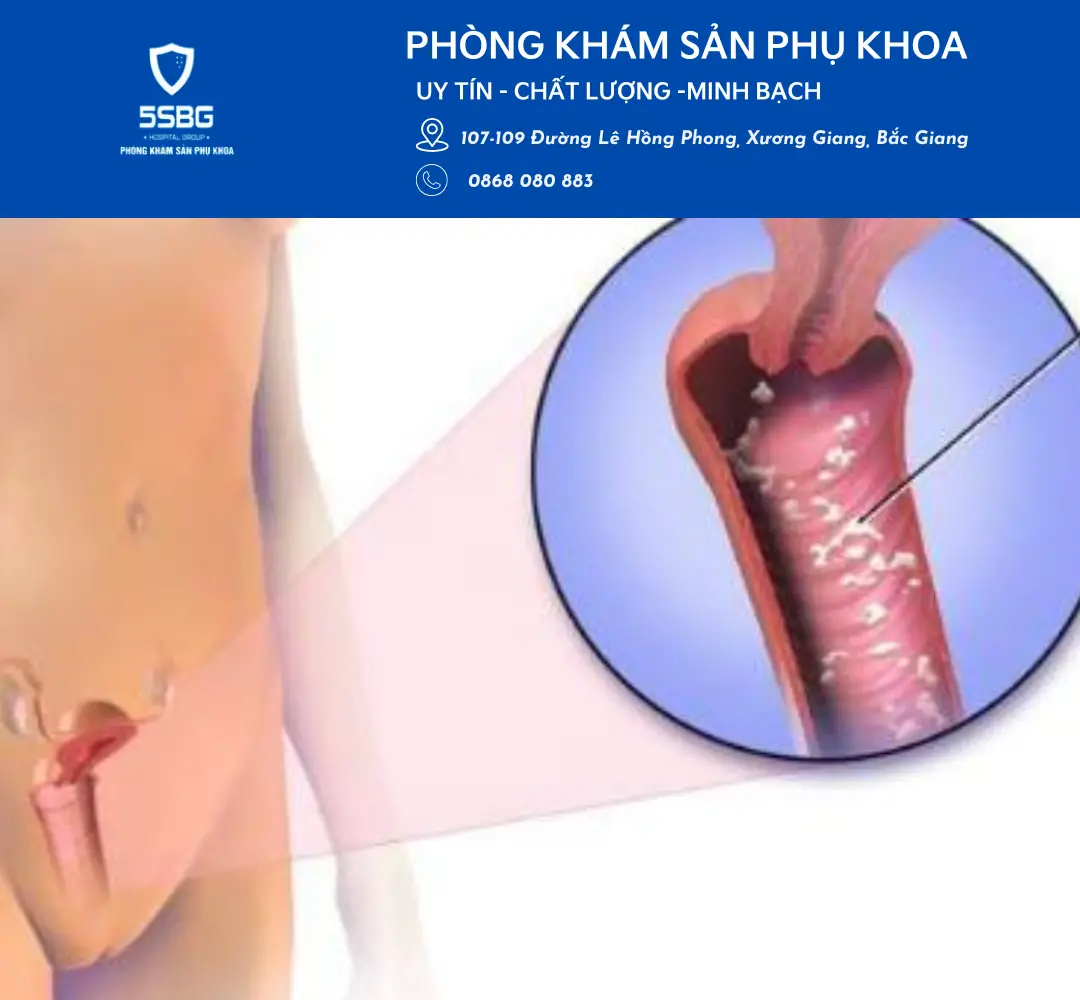 Viêm âm đạo do nấm Candida