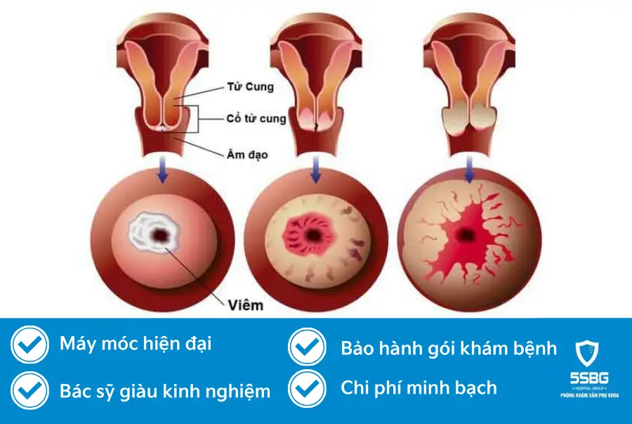 viêm nhiễm phụ khoa ảnh hưởng nghiêm trọng tới sức khỏe sinh sản